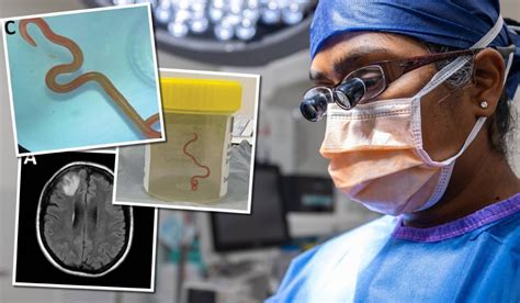 Australia: Neurosurgeon removes live worm from woman’s brain